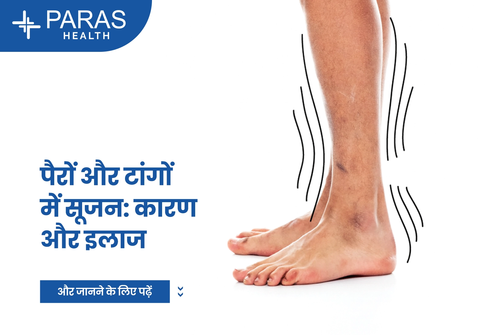 पैरों और टांगों में सूजन: कारण और इलाज